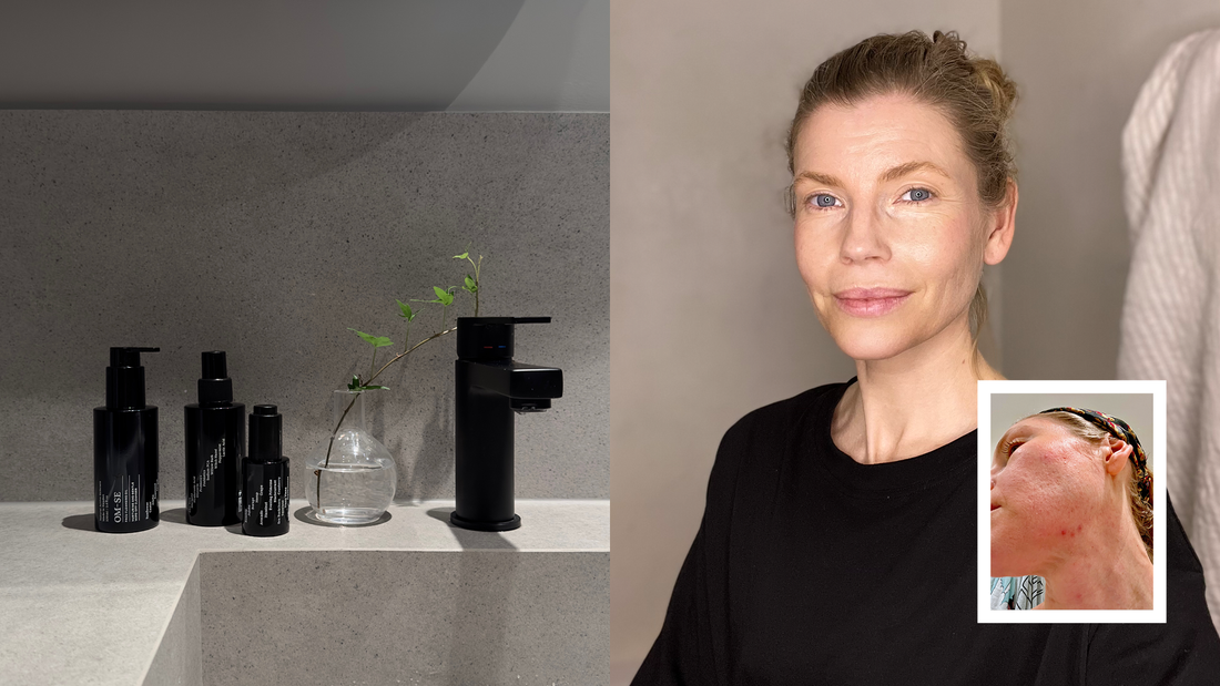 The skincare routine that saved my unbalanced skin